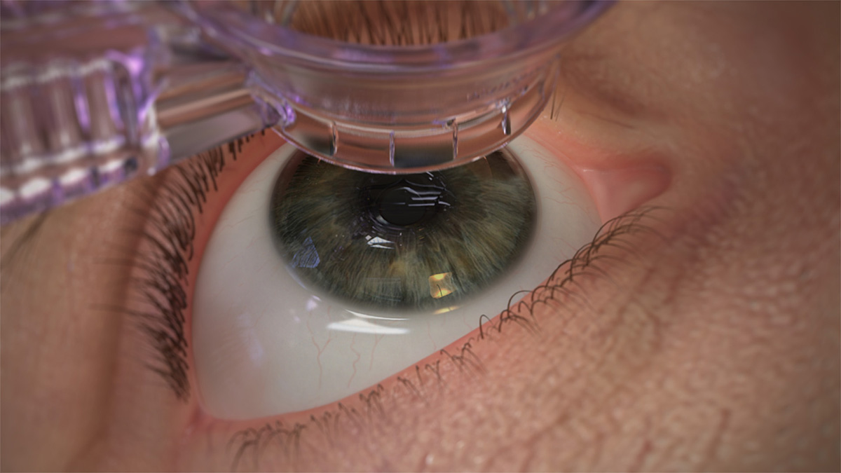 Ocular Suction Ring