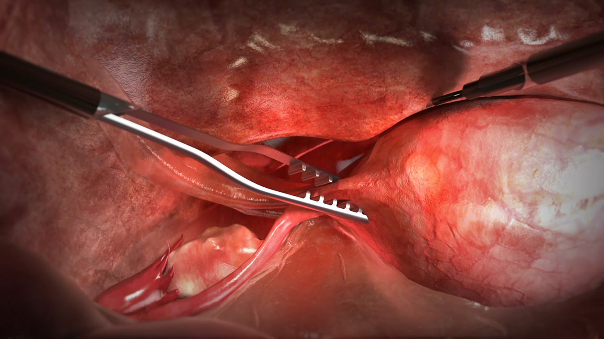 Minimally invasive surgery: percutaneous laparoscopy