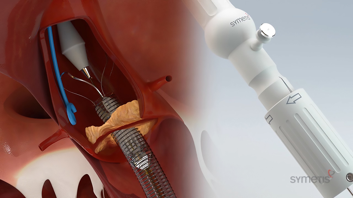 Minimally-invasive transcatheter aortic valve implantation (TAVI) device