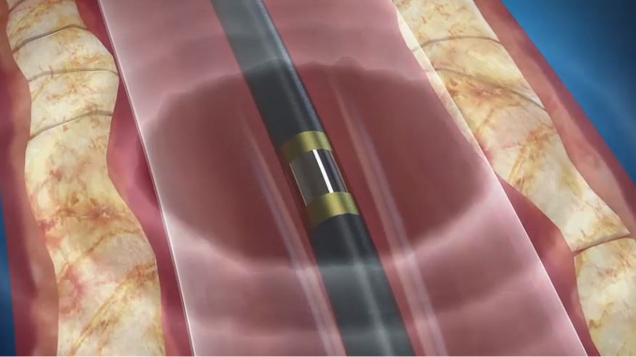 Medical Devices: Angioplasty, Lithotripsy and other Medical Devices  Animation | Elara